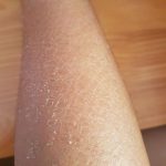 Da đen sạm và bị vàng lông do ảnh hưởng bởi hóa chất lột tẩy